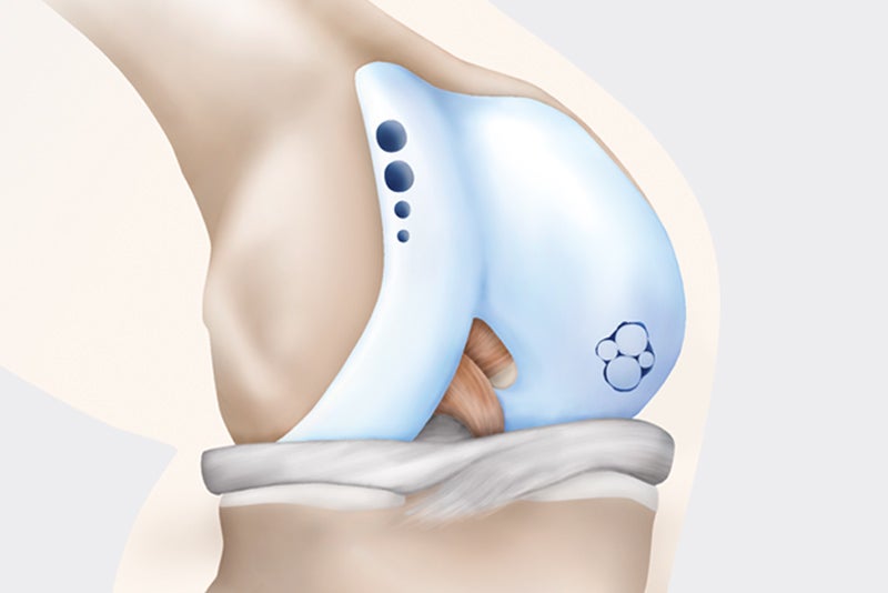 Osteochondrale Zylinder Transplantation