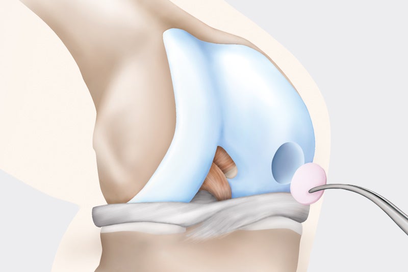 Autologe Knorpelzelltransplantation