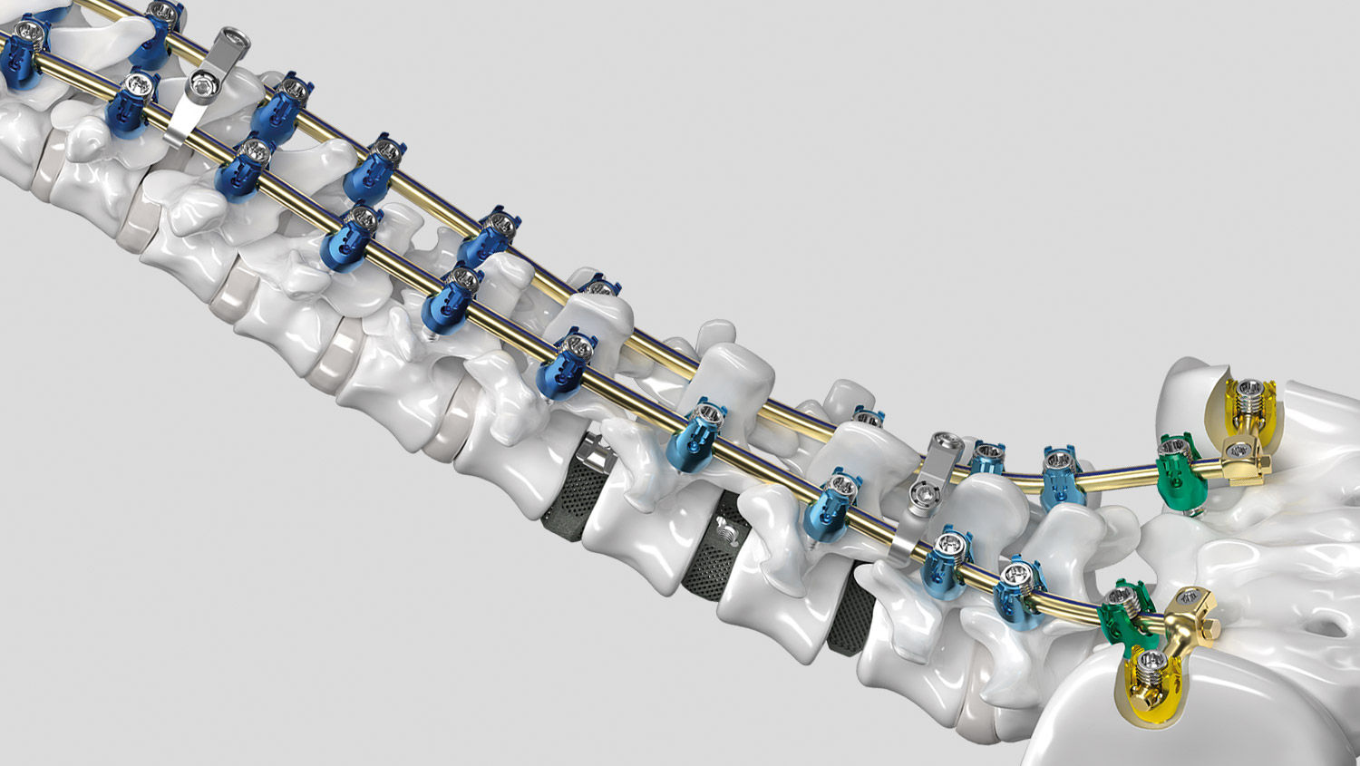 Ennovate® Thorakolumbar & Sacropelvic