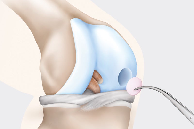 Autologe Knorpelzelltransplantation