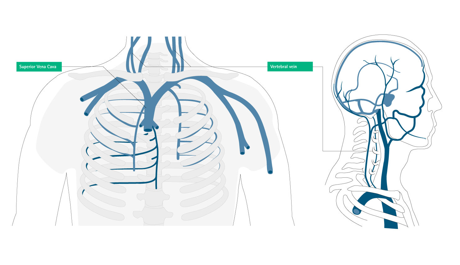 Fehlplatzierung obere Vena cava