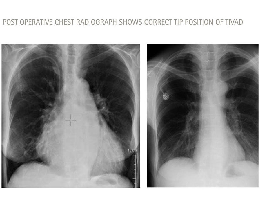 postoperatives Röntgenbild des Thorax