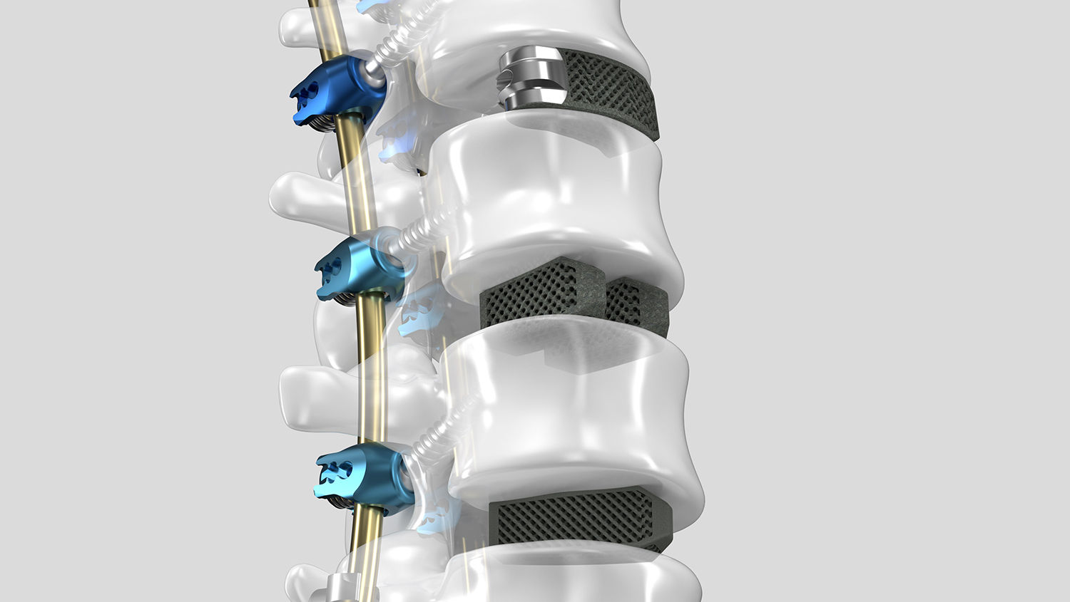 Ennovate® Thoracolumbar & Sacropelvic mit AESCULAP® 3D Interbody Fusion Geräten