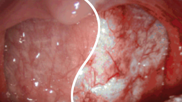 EinsteinVision® in der laparoskopischen Chirurgie mit roter Verstärkung