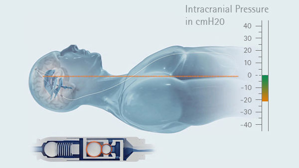 Graphischer intrakranieller Druck in horizontaler Position