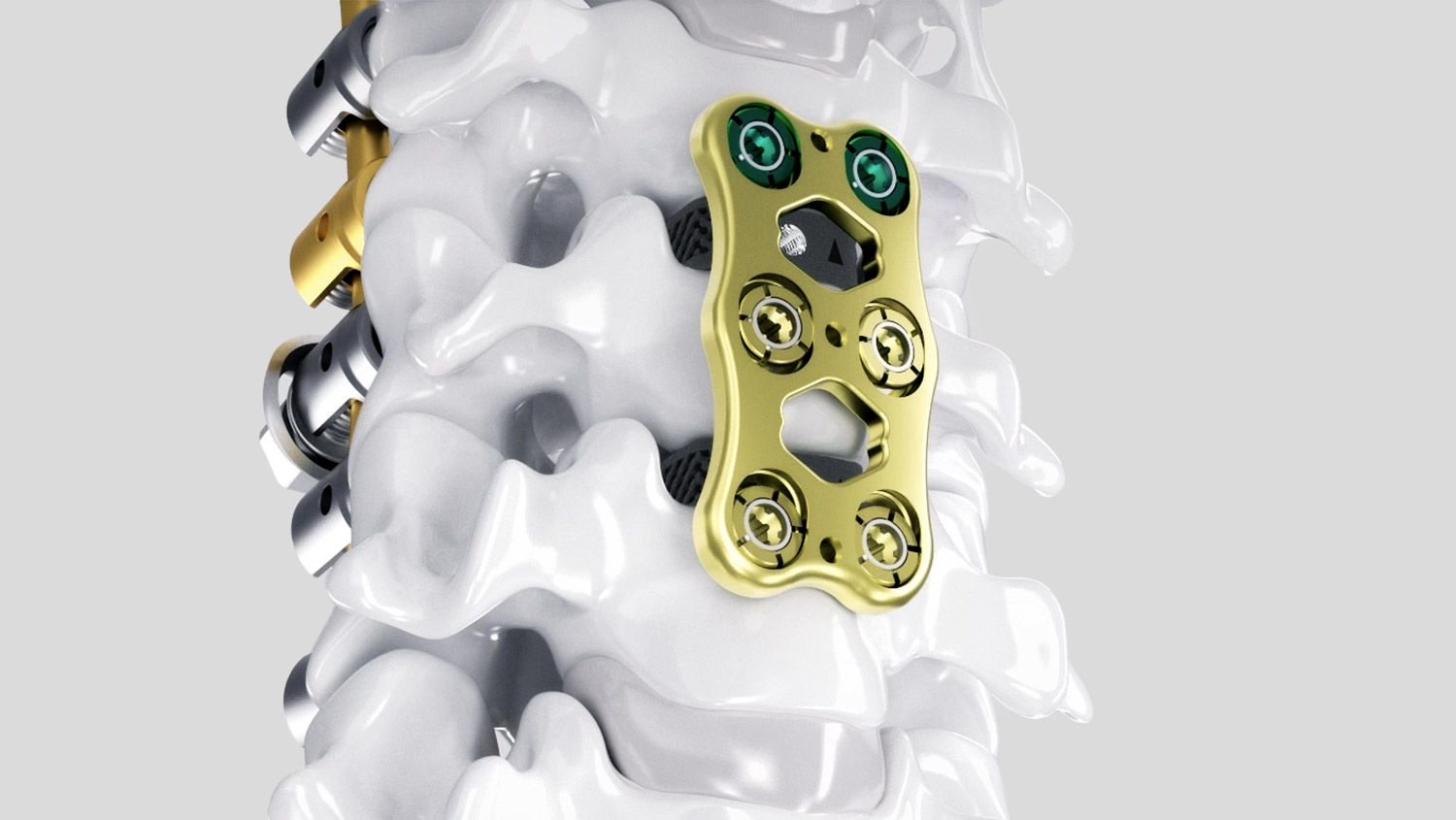 Ennovate® Cervical mit AESCULAP® CeSPACE® 3D und Quintex®