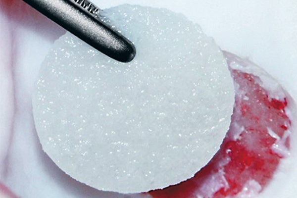 Autologes Knorpelzelltransplantat