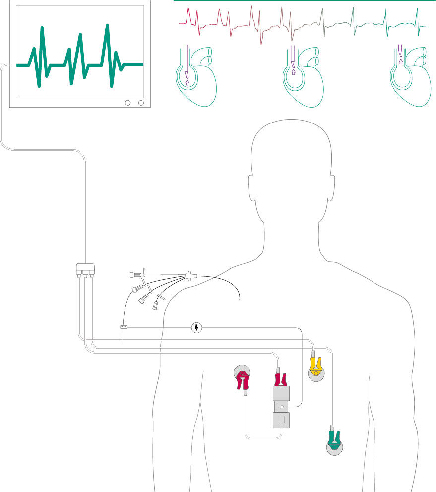 CVC-System